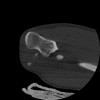 SPORK, NICO - 22.03.1976 - 02.08.2022 - CT obere Extremität - 17:51:17